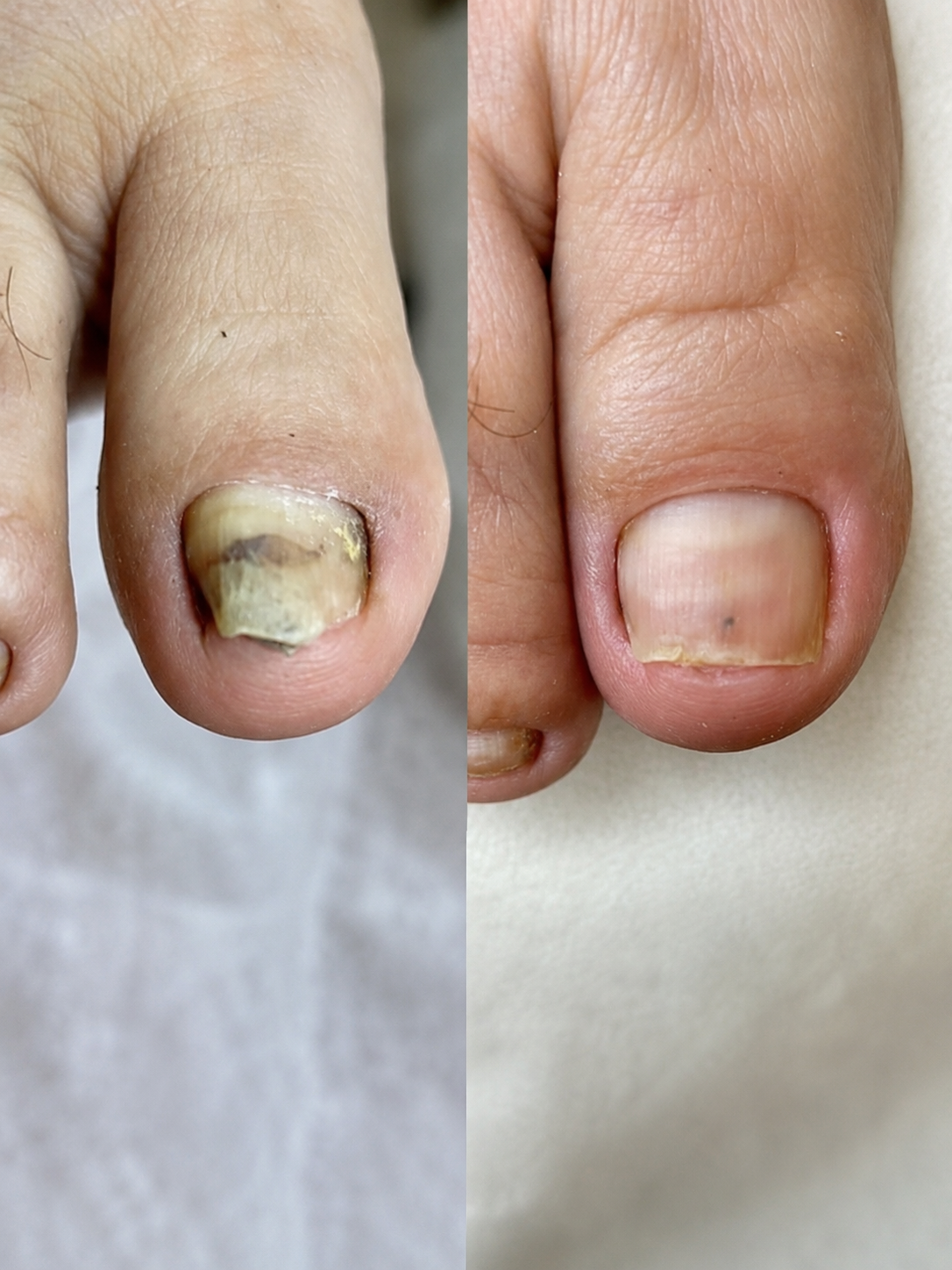 Nailvora MycoFix Mantar Karşıtı Tırnak Cihazı