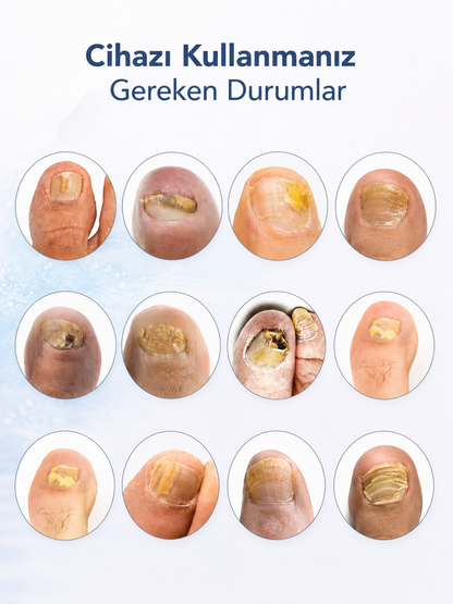 Nailvora MycoFix Mantar Karşıtı Tırnak Cihazı