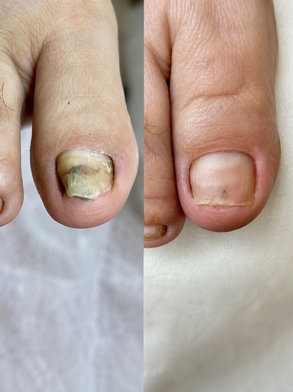 Nailvora MycoFix Mantar Karşıtı Tırnak Cihazı